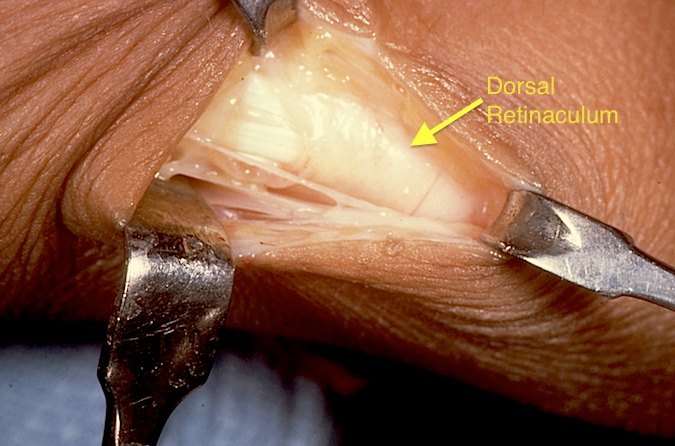 First extensor compartment fascia exposed