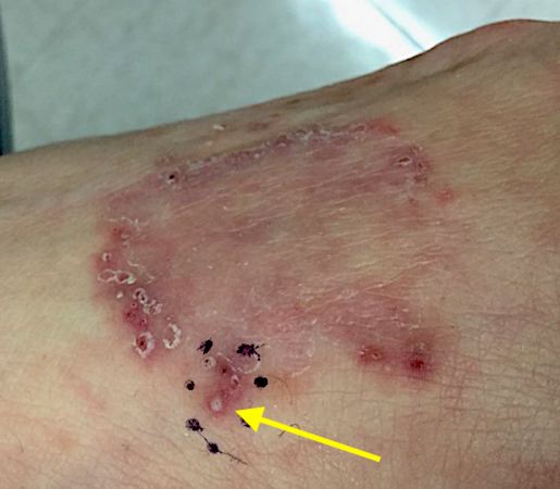 Dermatophytosis on dorsal right hand (arrow)