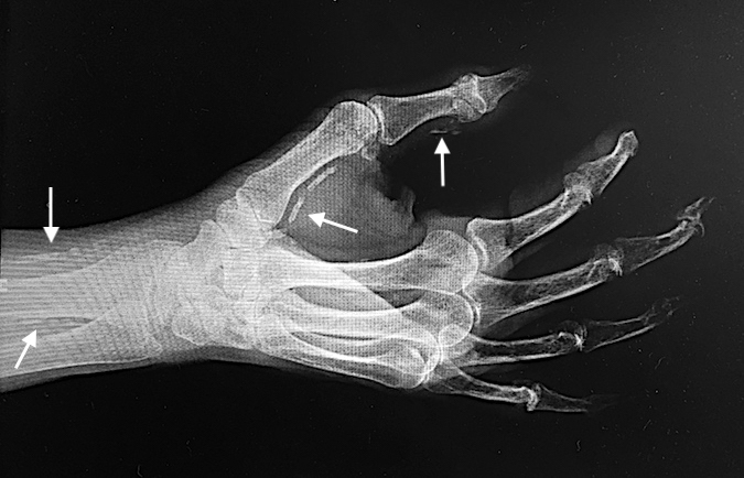 Calcified arteries in elder diabetic patient