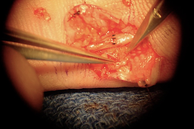 Right little finger ulnar digital microneurorrhaphy