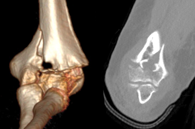 Closed three part adult Distal Humerus Fracture CT Scan