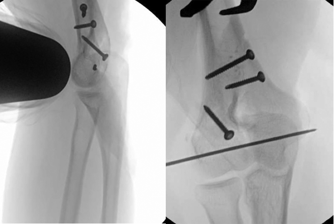 ORIF of Distal Humerus Fracture Preliminary Fixation