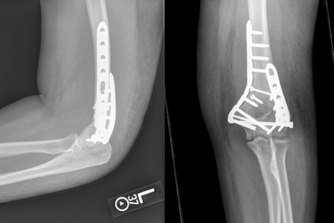 Completed ORIF of Distal Humerus Fracture 