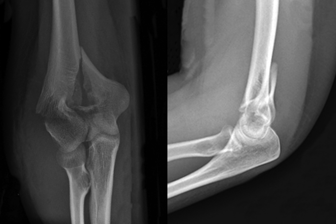 Closed three part adult Distal Humerus Fracture AP & Lateral views