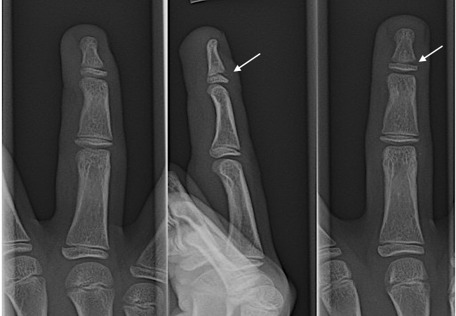 Distal Phalanx Salter I fracture (possible closed Seymour fracture). Note widening (arrow) of the physis (arrow)