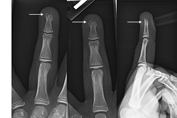 Distal Phalanx Tuft fracture (arrow)