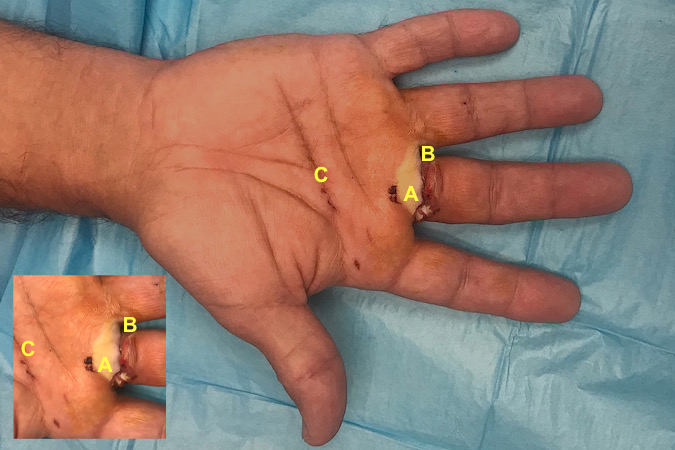 Dog Bite : (A)- macerated skin flap; (B)-Open wound; (C)-Teeth marks. Insert shows wound close-up.