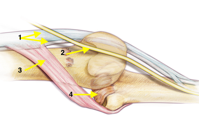 Palmar view of complex dorsal MP dislocation