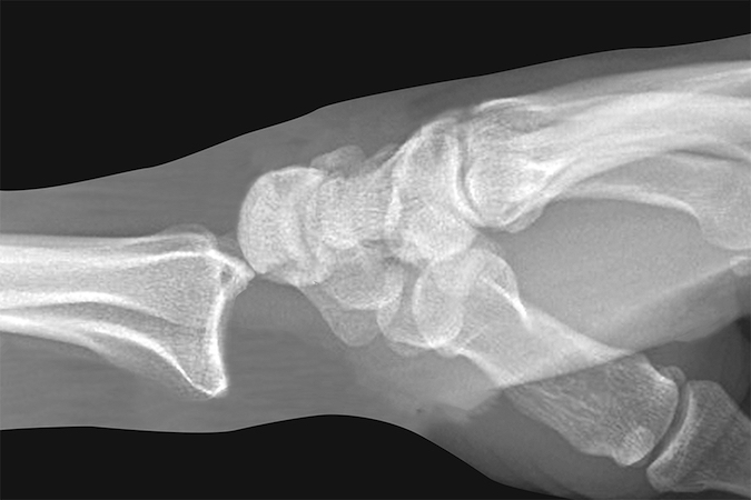 Diagrammatic lateral x-ray of a dorsal radiocarpal dislocation.  R-radius; L-lunate; C-capitate; Entire carpus is displaced dorsally.