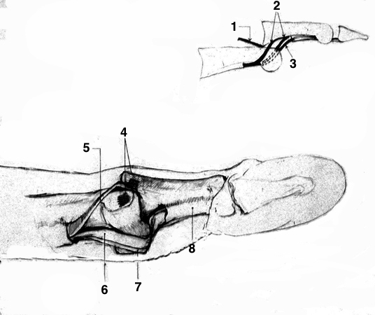 Complex Open PIP Dislocation by Flexor Tendons: In this very rare open injury the volar plate ruptures off the neck of the proximal phalanx and goes dorsal with the middle phalanx. The collateral ligament ruptures and the head of the proximal phalanx gets caught in a noose formed by one slip of the FDS on one side and the FDS slip & FDP on the other.  1-volar plate; 2-FDS Slips; 3-FDP; 4-collateral ligament; 5-FDS Slip; 6-FDP; 7-Other FDS Slip; 7- A-4 pulley