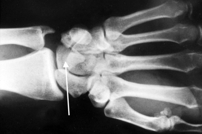 Left dorsal perilunate dislocation AP X-ray. Note triangular lunate (arrow) with the "piece of pie" sign and disruption of Gilula's lines.