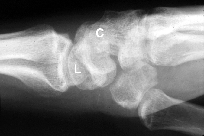 Left dorsal perilunate dislocation lateral X-ray. Note capitate (C) and lunate (L).