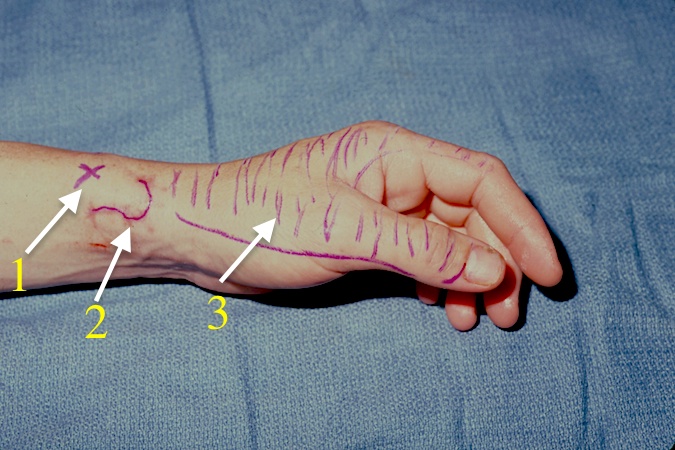 Left dorsal radial sensory nerve laceration at "X" (1); Radial styloid outlined (2); cross marked area where patient is experiencing numbness and paresthesias (3).