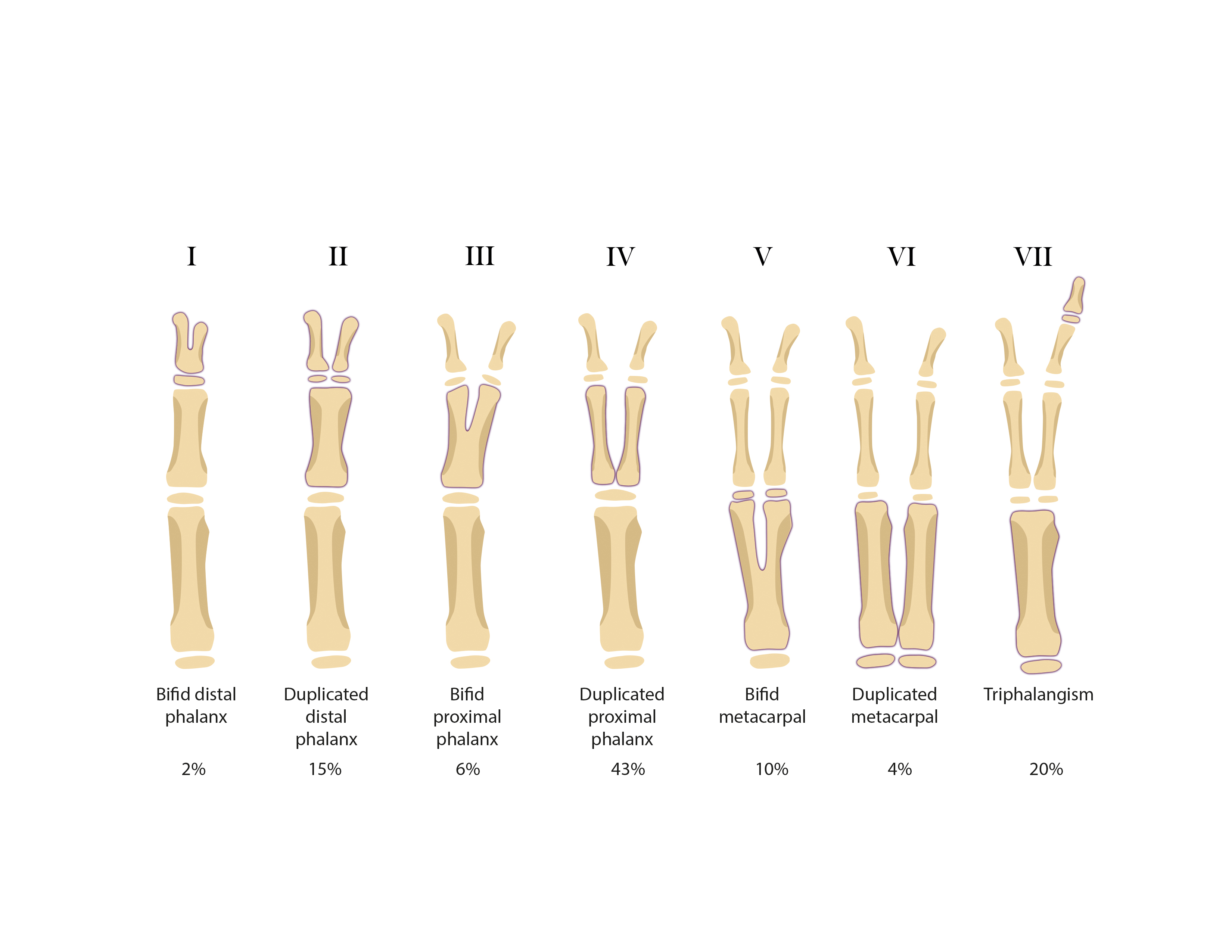 Wassel's Duplicate (Bifid) Thumb Classification modified from Wassel (ref-1)