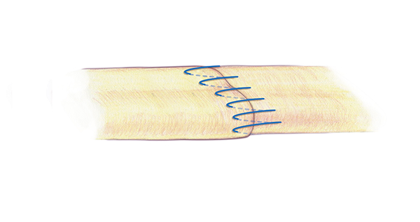 A separate second simple running  for the edge or epitenon part of the flexor tendon repair is very important. This simple running suture is appropriate suture technique for this repair . A 6-O nylon is one acceptable suture for the epitenon repair