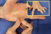 Extreme fifth finger PIP hyperextension i.e. joint hypermobility in an old patient with mild Ehlers-Danlos Syndrome