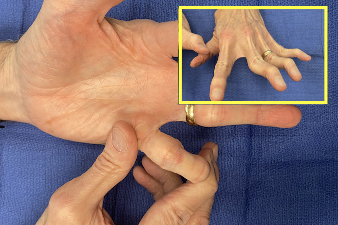 Extreme fifth finger PIP hyperextension i.e. joint hypermobility in an old patient with mild Ehlers-Danlos Syndrome