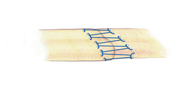 A separate second simple locking running  for the edge or epitenon part of the flexor tendon repair is very important. This simple running suture is appropriate suture technique for this repair . A 6-O nylon is one acceptable suture for the epitenon repair