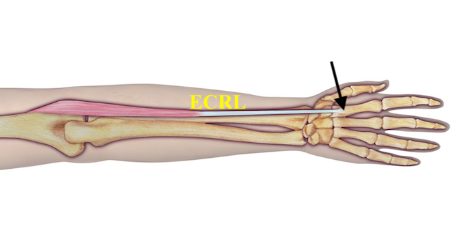 Site of ECRL avulsion (arrow)