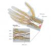 The extensor carpi radialis longus tendon (ECRL) has been released from the base of the index metacarpal and transferred to the combined flexor digitorum profundus tendons (FDP II - V). The extensor carpi radialis longus is passed through the profundus tendons which have been sutured together. Alternatively, the extensor carpi radialis longus tendon can be split into two halves with the flexor digitorum profundi sutured to the ECRL as shown in the insert. 