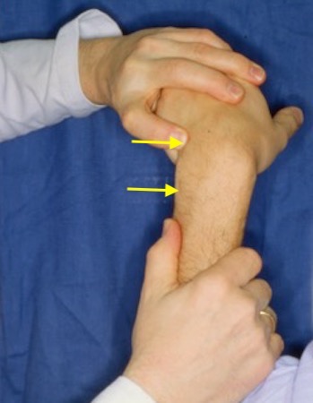 ECU tendon (arrow) subluxation is demonstrated supinating the forearm while flexing and ulnar deviating the wrist.