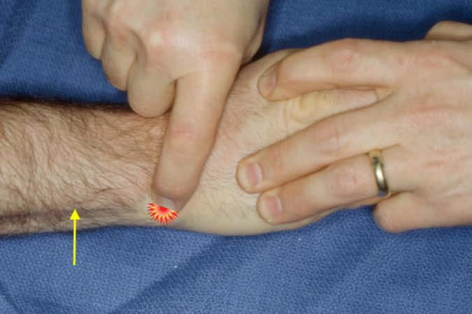 ECU tendon (arrow) is being palpated for tenderness and laxity