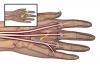 Laceration of the extensor tendons (insert 1) has lead to adhesions (2) and resultant extrinsic tightness with restricted ring and little finger motion.