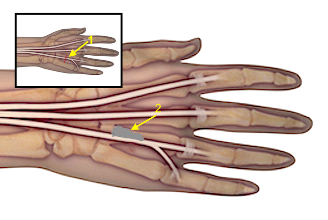Laceration of the extensor tendons (insert 1) has lead to adhesions (2) and resultant extrinsic tightness with restricted ring and little finger motion.