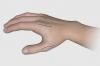 This drawing shows the dorsal incisions for the extensor indicis (EIP) transfer to the thumb abductor tendon.