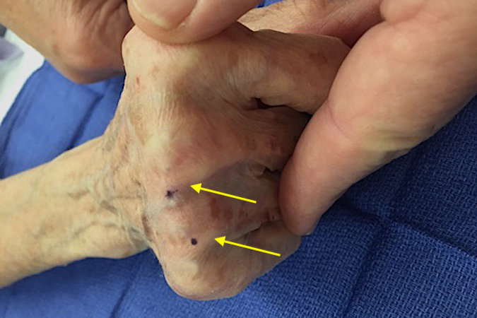 Note how the ulnar subluxation of the extensor tendons is exacerbated by finger flexion (arrows).