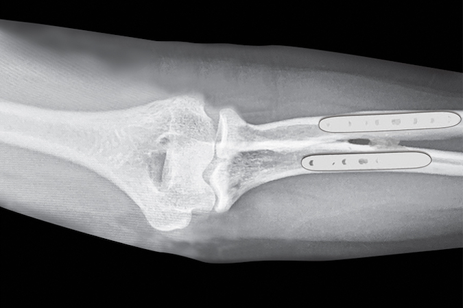 Viance Type III post-traumatic radioulnar synostosis