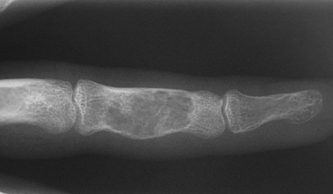 Enchondroma ring finger middle phalanx AP view. Note the cortical thinning and expansion.