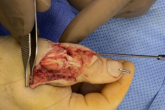 ORIF of fracture with K-wire completed.  Core sutures have been placed and 6-O nylon epitendinous suture being placed.