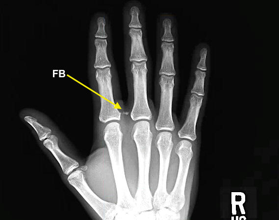 Retained glass after laceration near base of right index finger