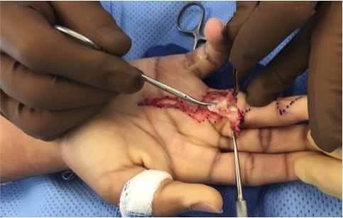 Retracted scarred FDP being dissected free at distal edge of A-2 pulley after opening cruciate pulley at PIP joint.