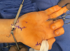 FDS IV Opponensplasty without a carpal tunnel release. FDS release at base of the ring, passed through the carpal tunnel to the distal wrist crease near the FCU.