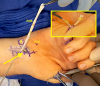 FDS IV passed around the FCU. Clamp passed subcutaneously from thumb MP to wrist incision to grasp the FDS (arrow). Insert shows both FDS slips at the MP joint area. FDS to sutured to the abductor conjoined tendon. 