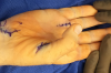 Incisions closed.  Wrist dorsiflexion flexes thumb IP joint and opposes thumb to base of long finger.  With wrist neutral thumb should align with he base of the index.