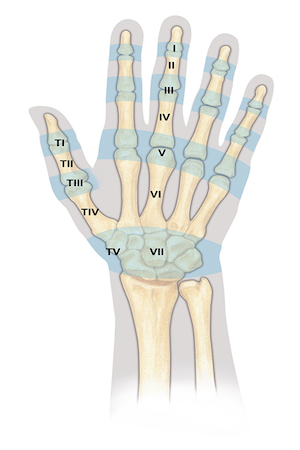 Extensor Tendon Zones of Injury. Zone I to Zone VII for the fingers, hand and wrist. Zones TI to Tv for the thumb.