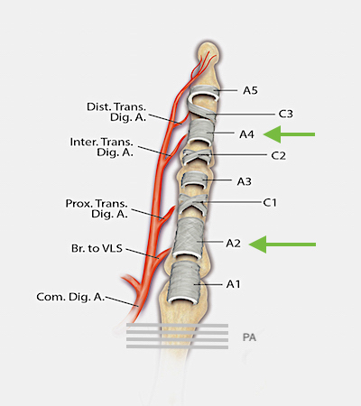 This diagram highlights the vascular supply and components of the flexor tendon sheath. The three cruciate pulleys (C1-3), the five annular pulleys (A1-A5) and the palmar aponeurotic pulley (PA) are shown. The A2 and A4 pulleys are the biomechanically the most important pulleys. During flexor tendon surgery, Tang(ref14) has shown that the A2 pulley can be 50% excised or vented and the A4 can be 100% vented if needed for tendon excursion if the other parts of the sheath are intact.