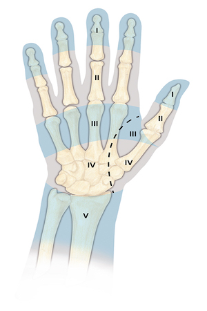 Flexor Tendon Zones of injury for fingers, thumb, hand and wrist.  The most difficult repairs are those done in Zone II where the fibro osseous tunnel of the flexor tendon sheath is narrow and tight
