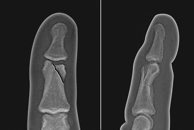 Displaced angulated intra-articular middle phalanx condylar fracture