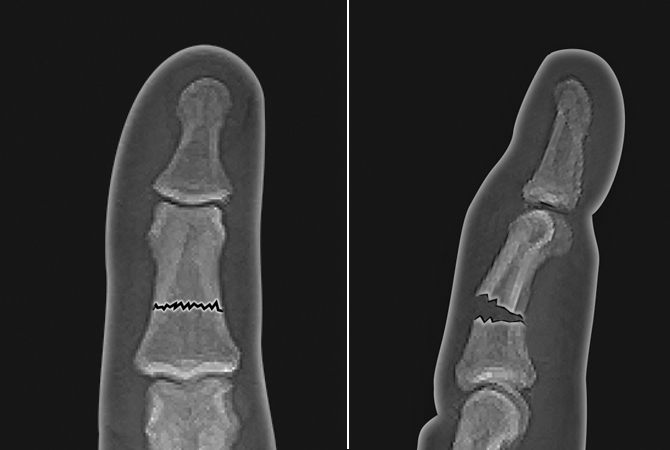 Non-displaced middle phalanx angulated shaft fracture