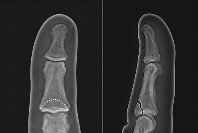 Non-displaced central slip intra-articular middle phalanx base fracture