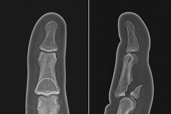 Displaced solar plate  intra-articular avulsion of the middle phalanx base fracture