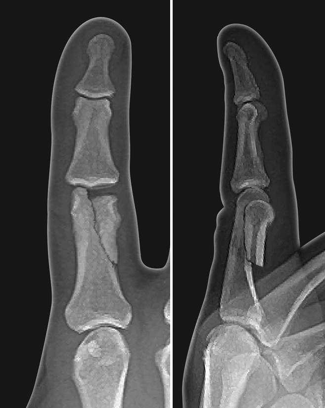 Displaced unicondylar intra-articular proximal phalanx fracture