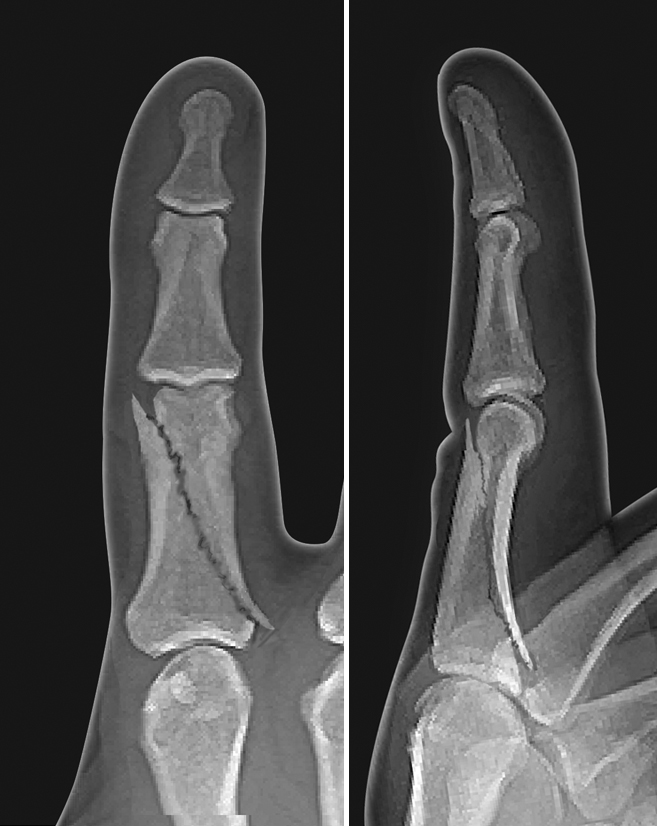 Displaced oblique proximal phalanx shaft fracture