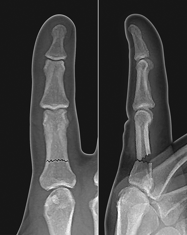 Angulated proximal phalanx P1/3 M1/3 shaft fracture