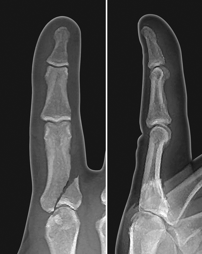 Displaced unicondylar intra-articular proximal phalanx base fracture