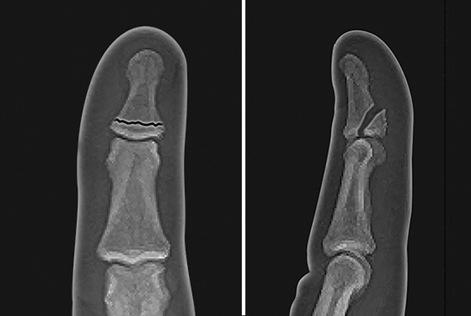 Moderately displaced flexor digitorum profundus avulsion fracture